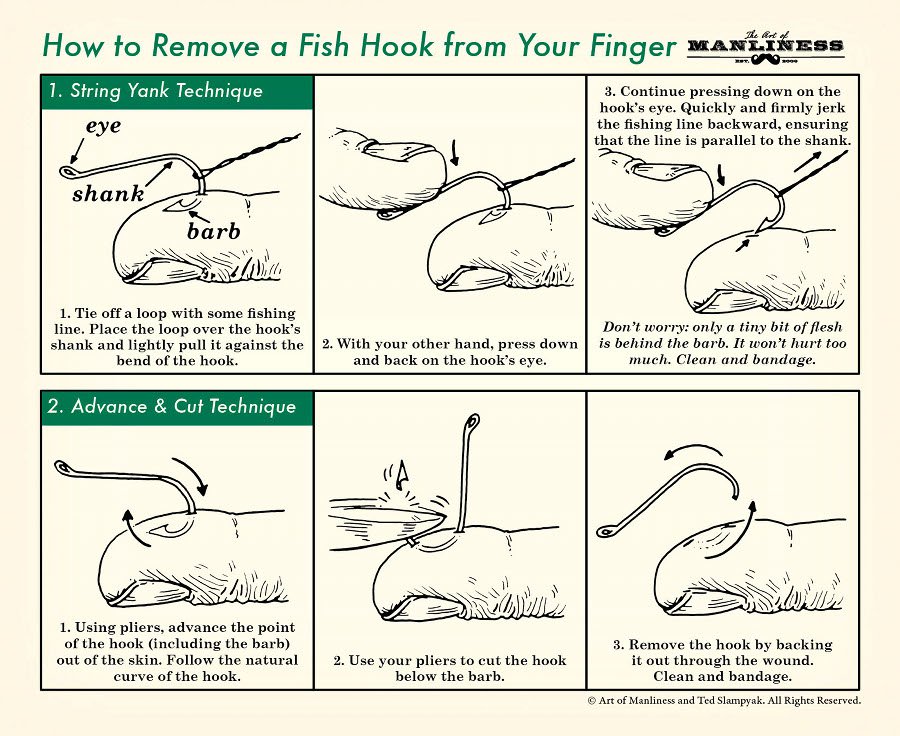 Remove A Fish Hook From Your Finger In Three Simple Steps
