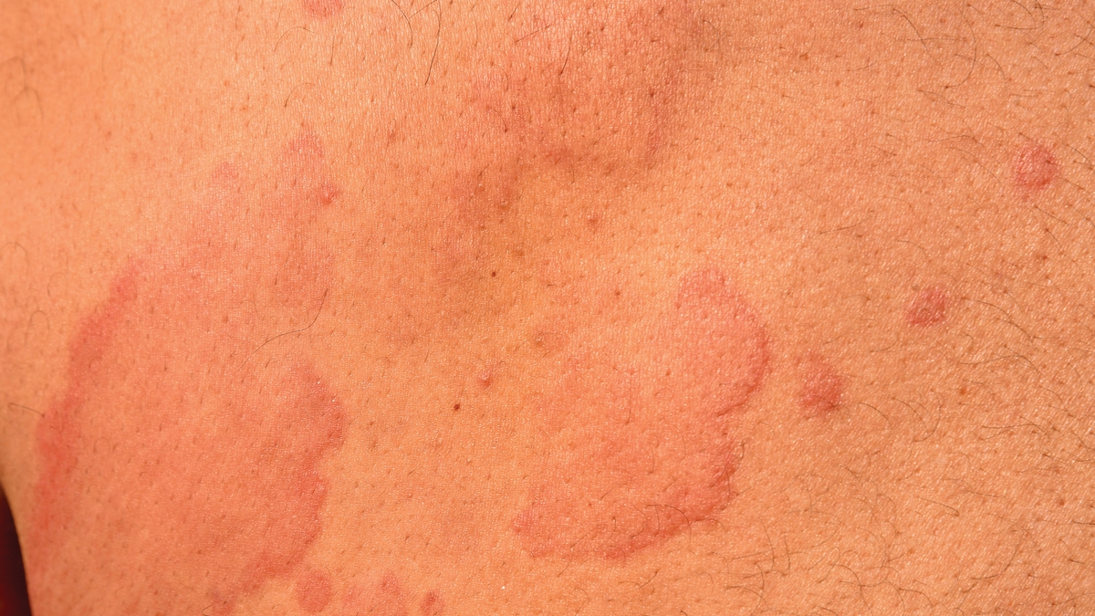 What Are Hives The Common Skin Condition Giving You Itchy Red Bumps